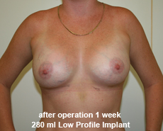 plastic-surgery-breast-augmentation